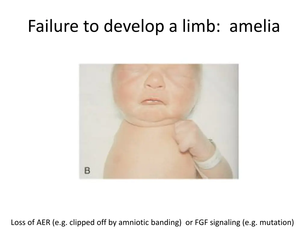 failure to develop a limb amelia