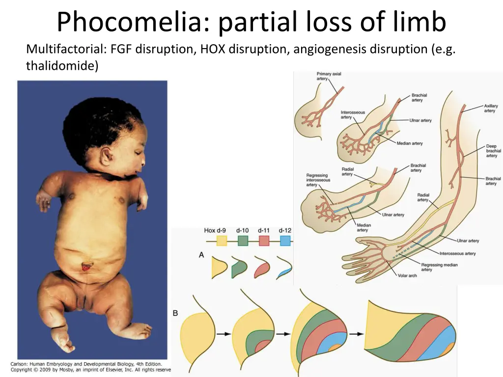 phocomelia partial loss of limb multifactorial