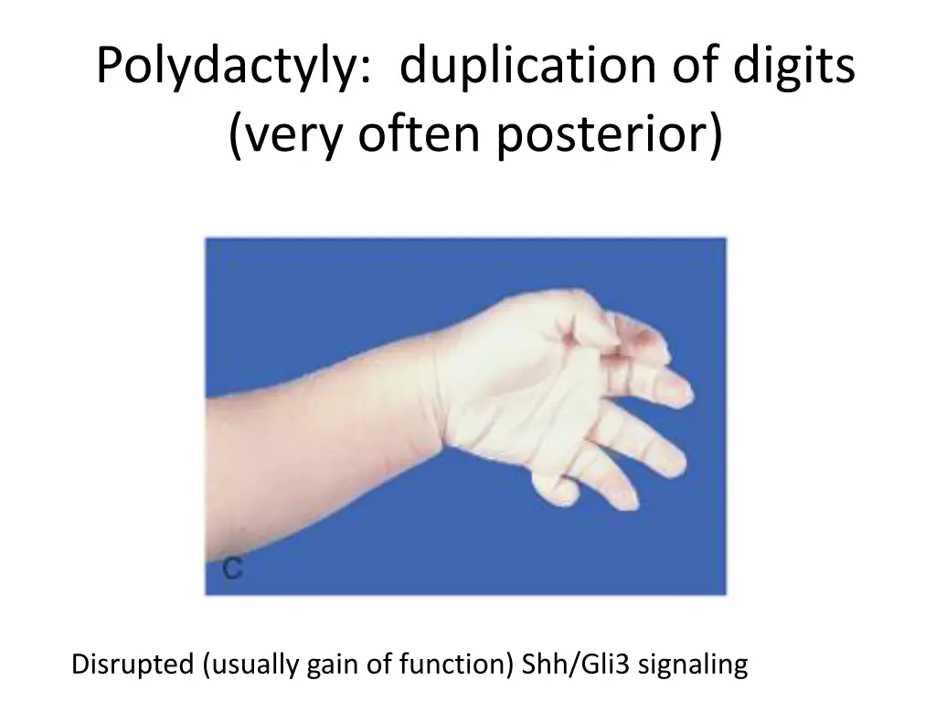 polydactyly duplication of digits very often