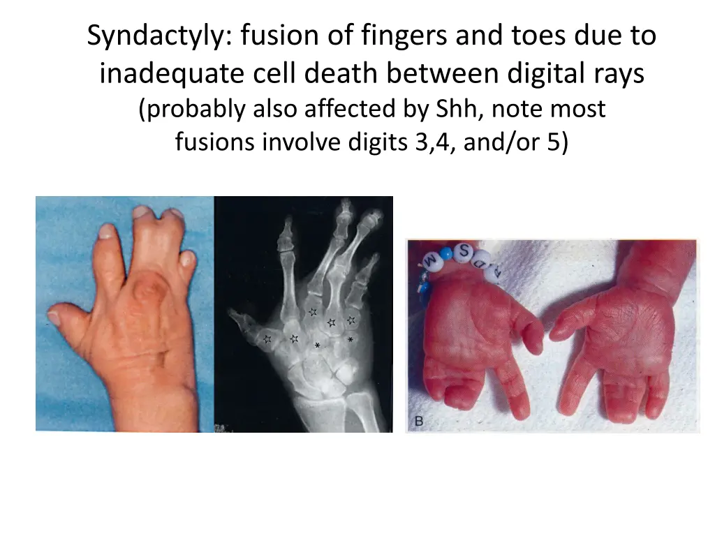 syndactyly fusion of fingers and toes