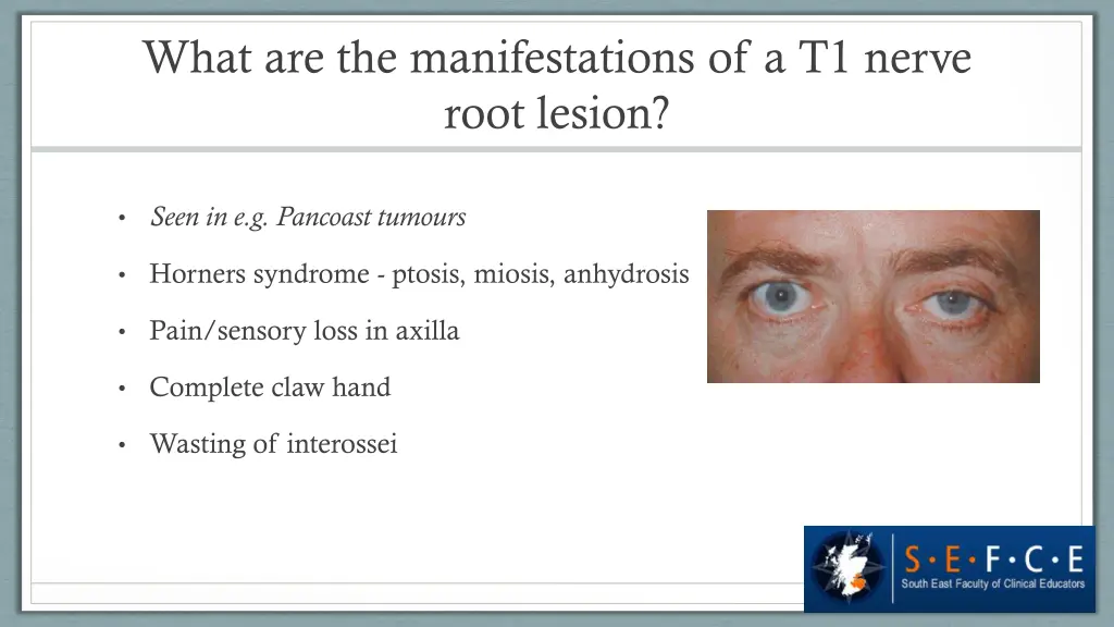 what are the manifestations of a t1 nerve root