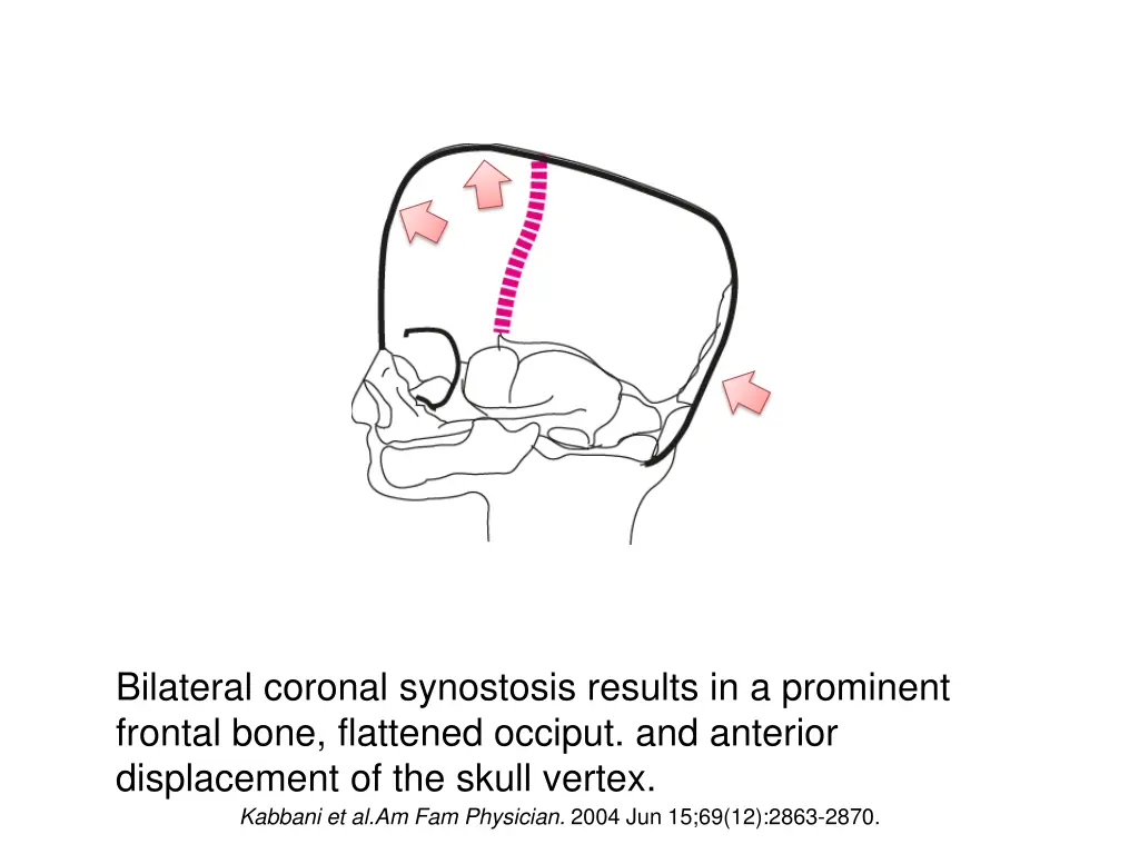 bilateral coronal synostosis results