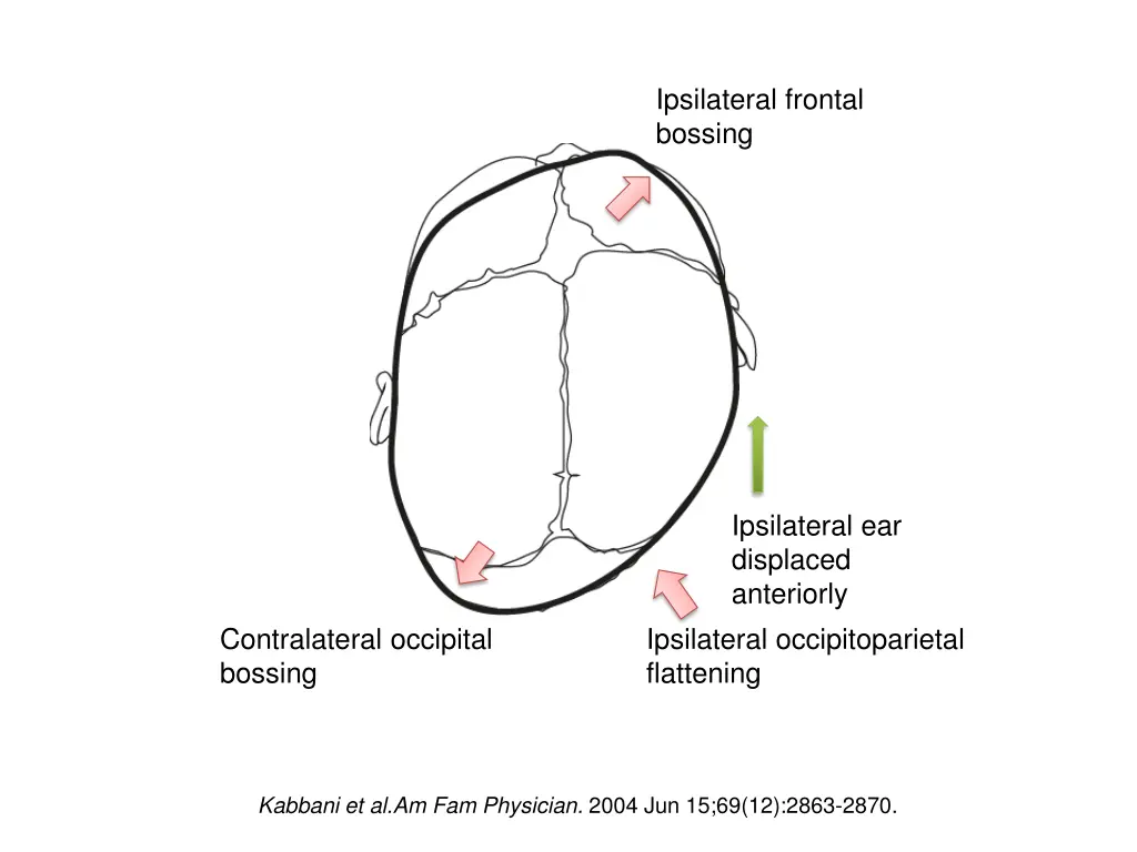 ipsilateral frontal bossing