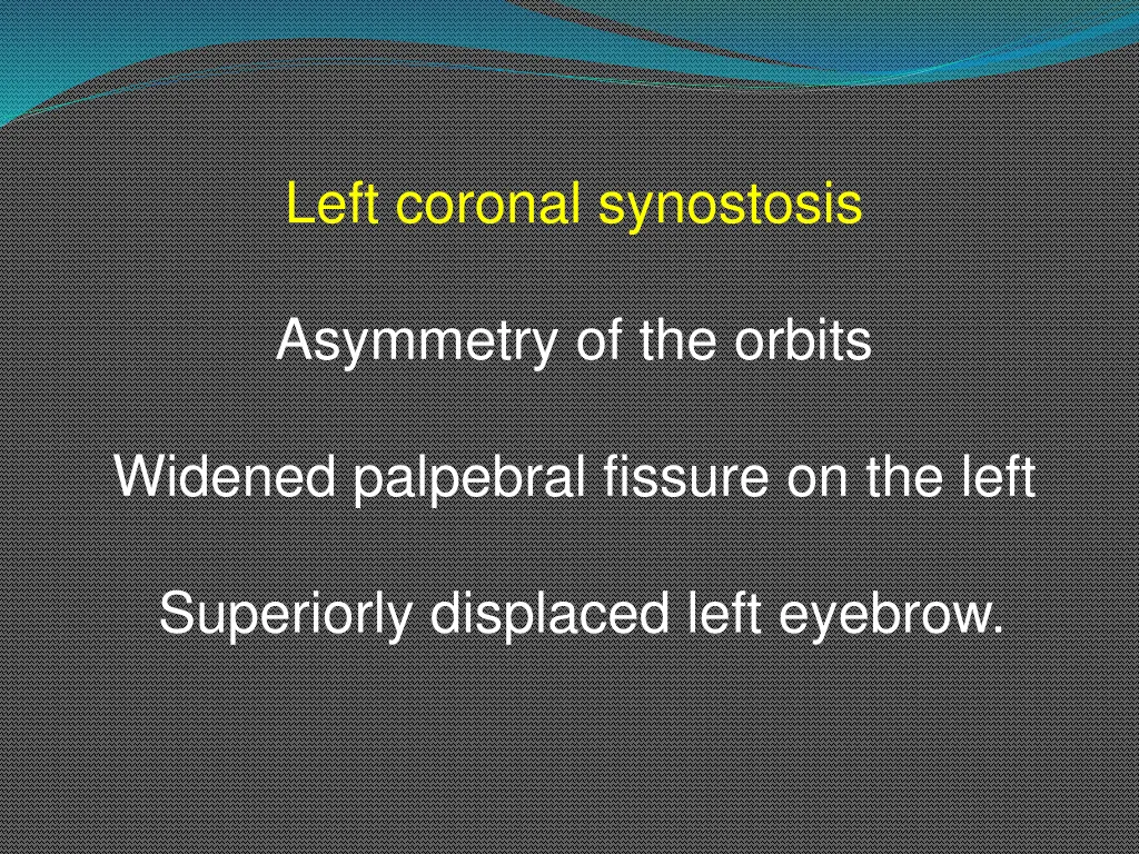 left coronal synostosis