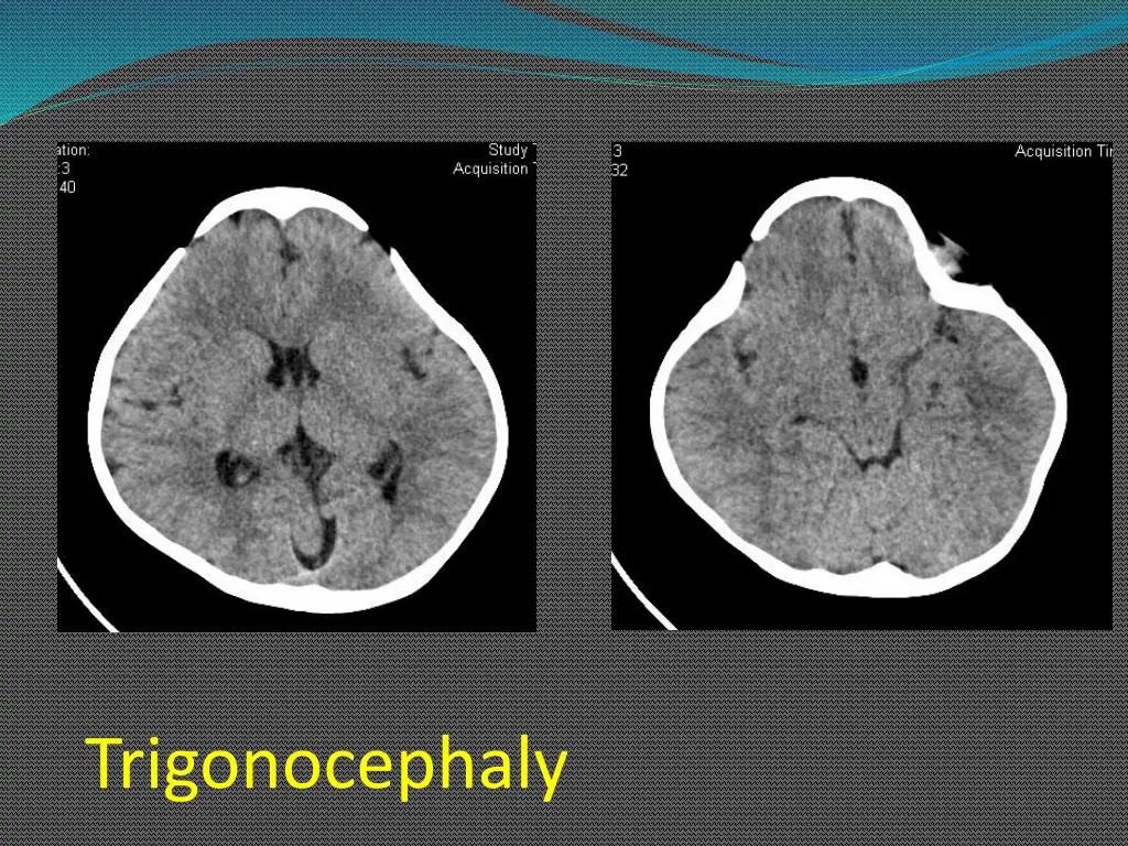 trigonocephaly 1