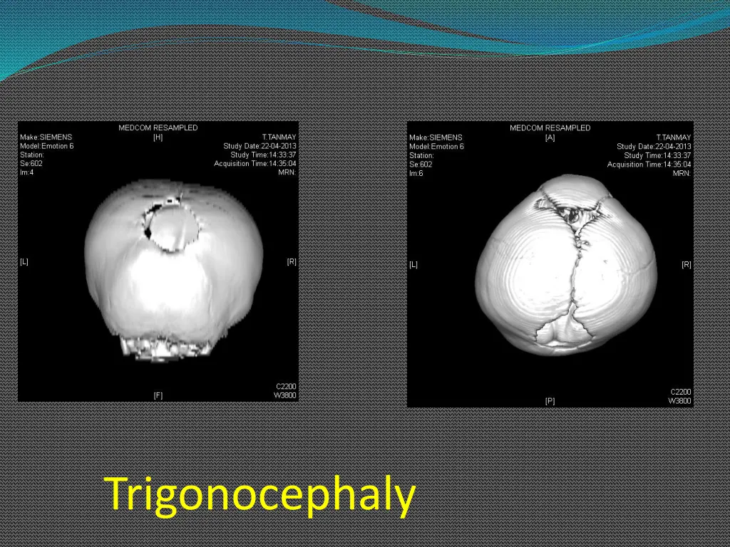 trigonocephaly 2