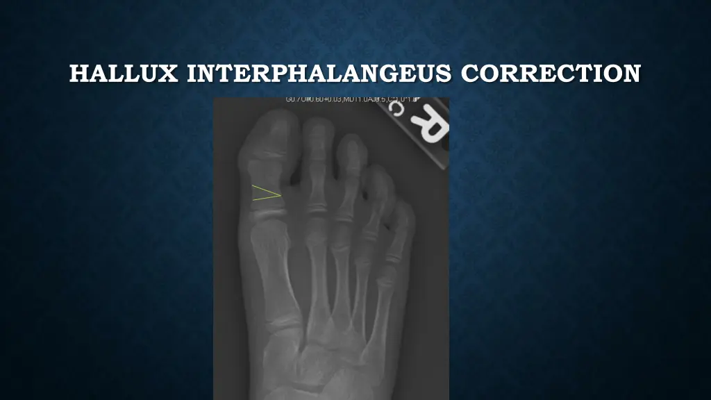 hallux interphalangeus correction