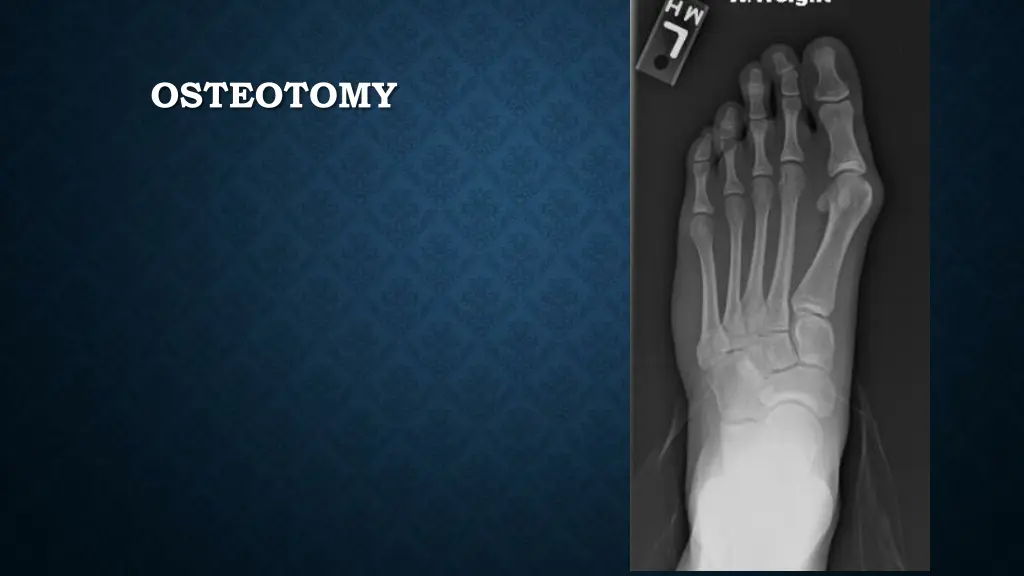 osteotomy