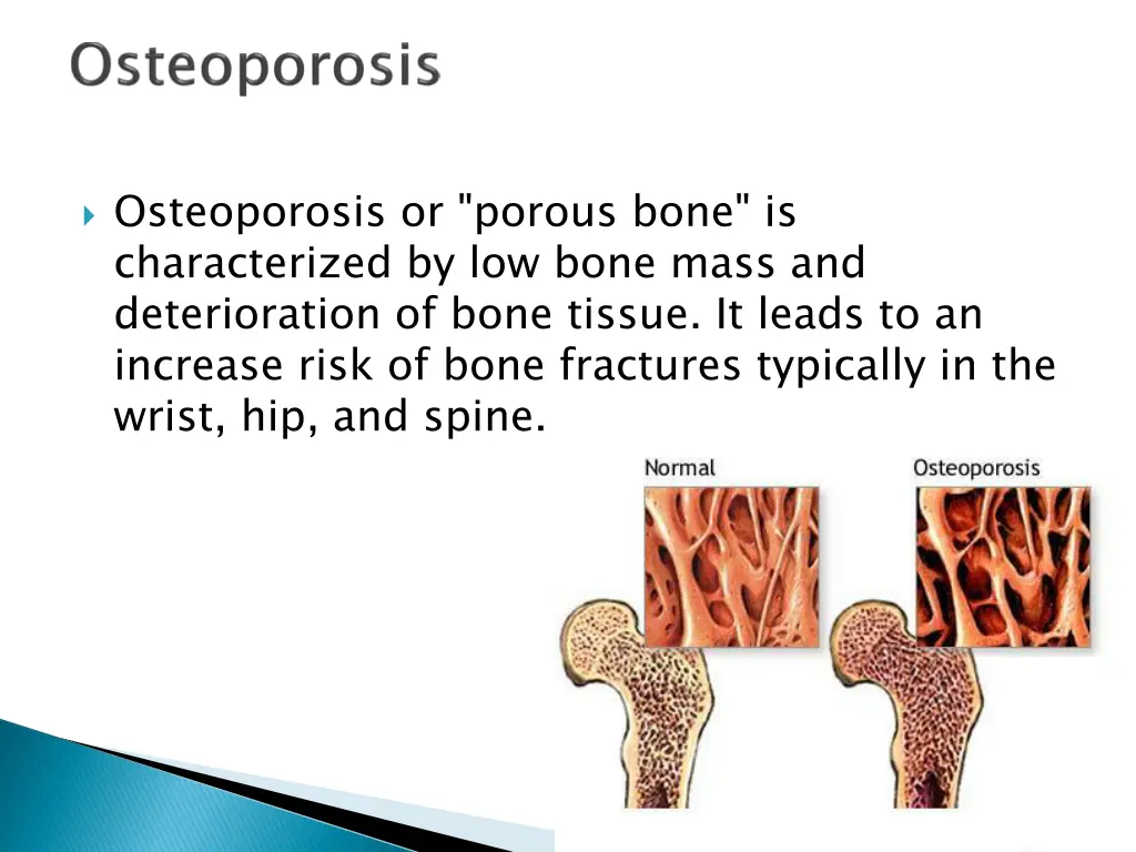 osteoporosis or porous bone is characterized