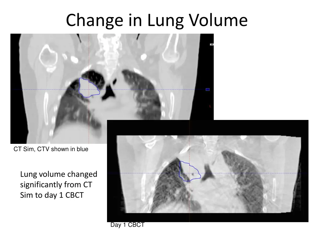 change in lung volume