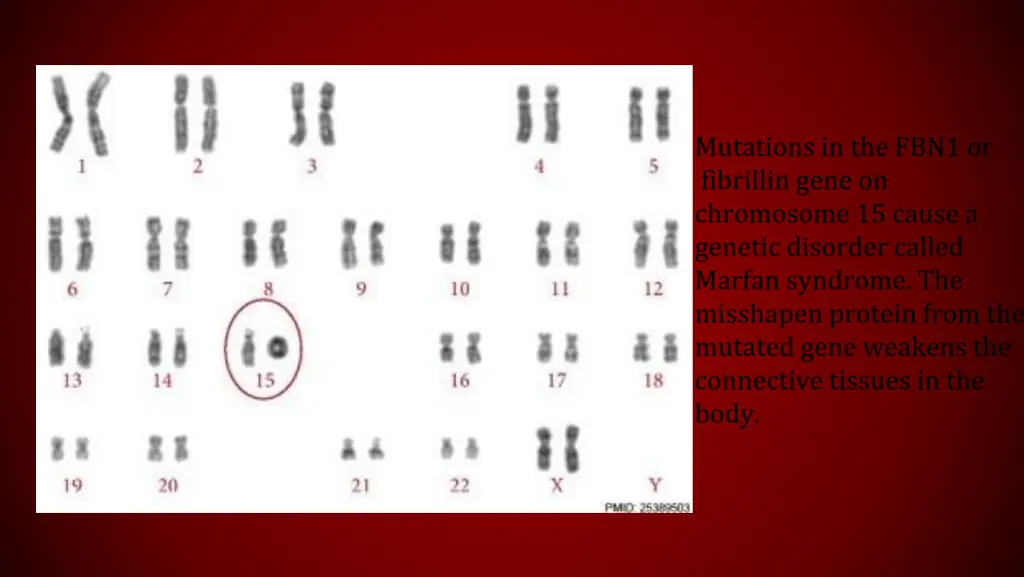 mutations in the fbn1 or fibrillin gene