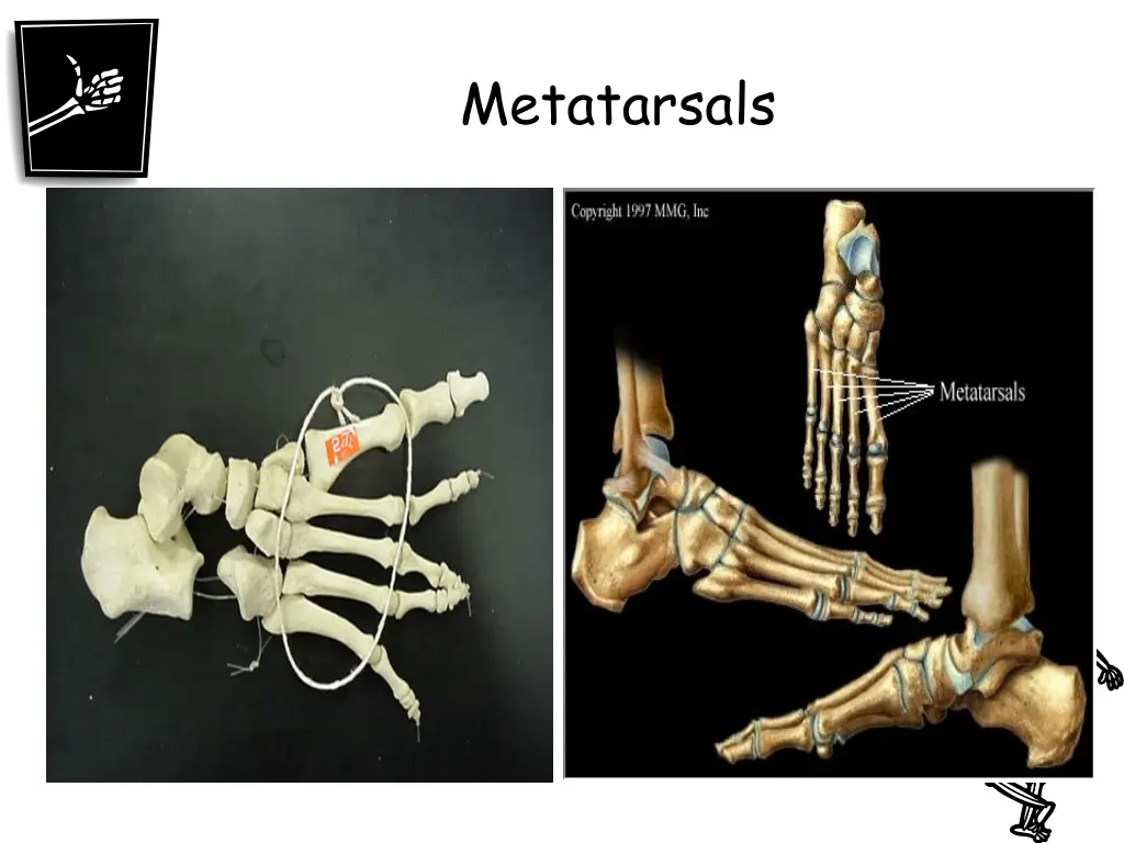 metatarsals