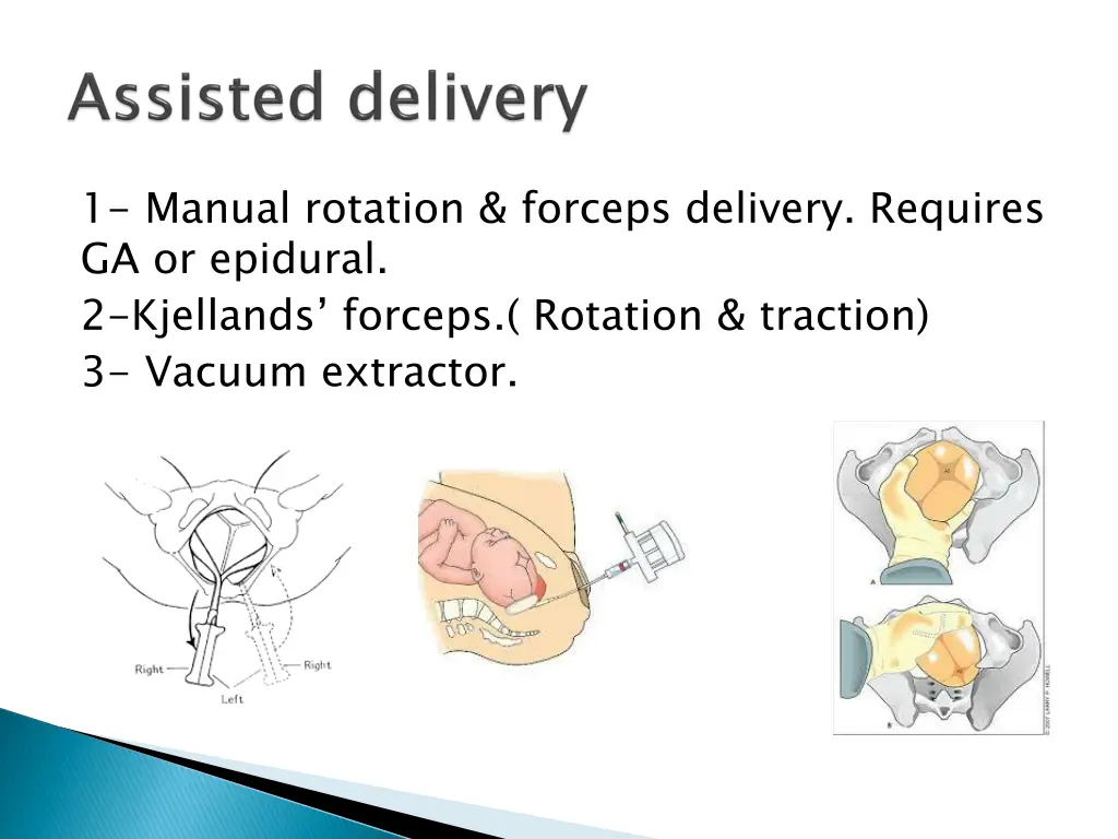 1 manual rotation forceps delivery requires