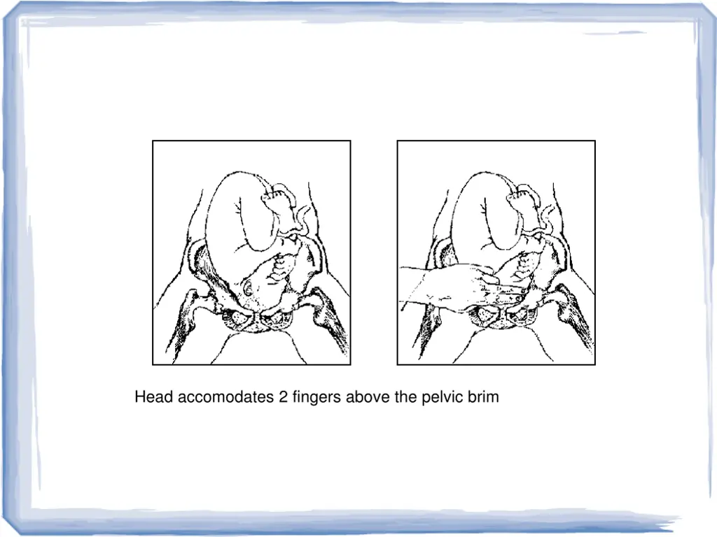 head accomodates 2 fingers above the pelvic brim