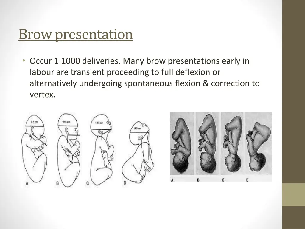 brow presentation