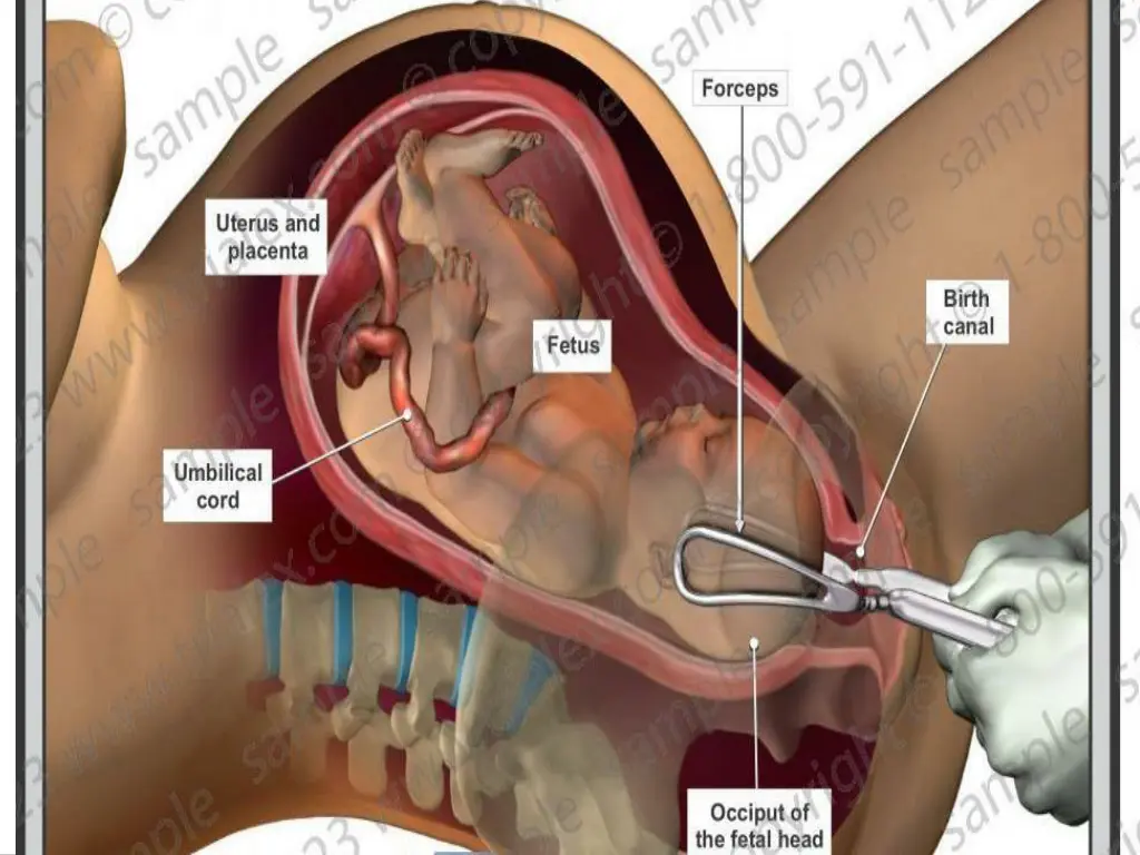 image result for forceps delivery occiput