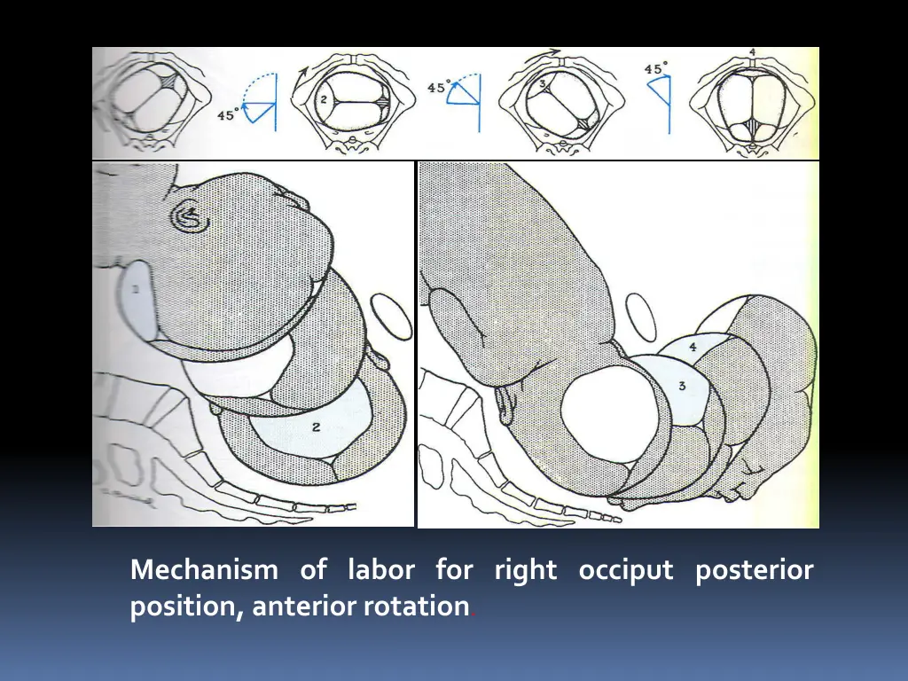 mechanism of labor for right occiput posterior