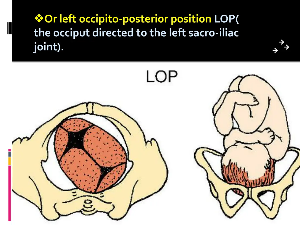 or left occipito posterior position