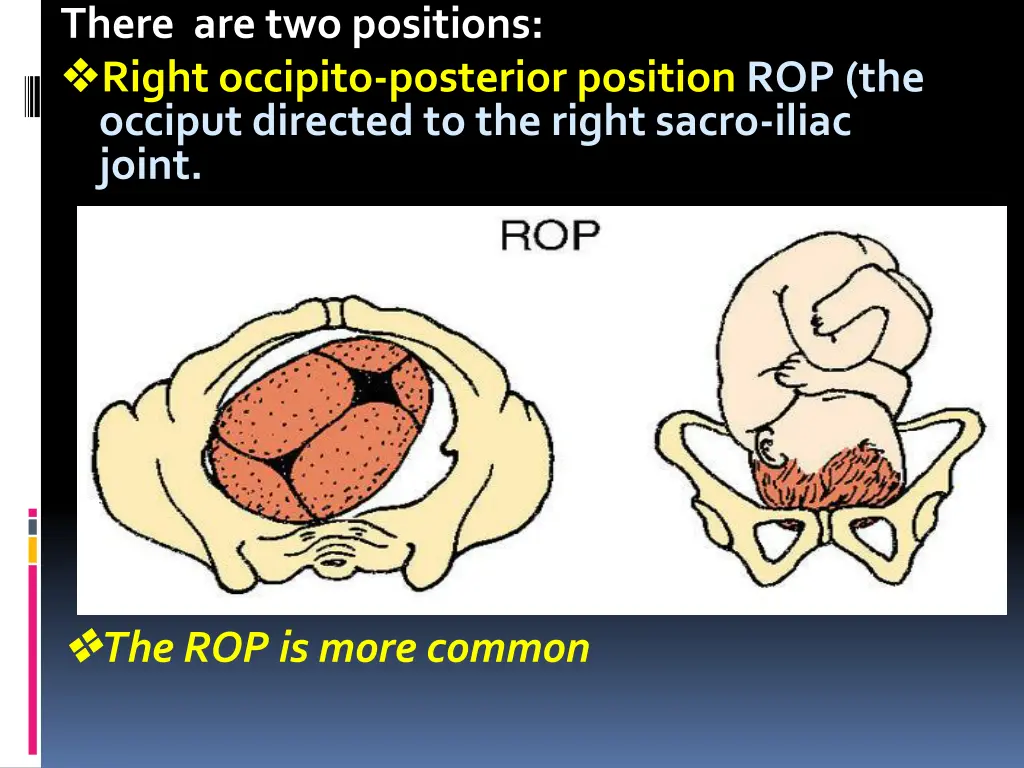 there are two positions right occipito posterior