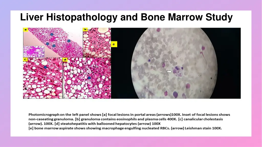 liver histopathology and bone marrow study