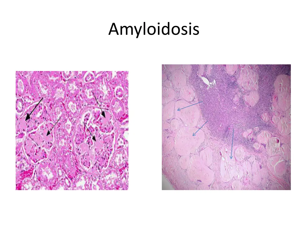 amyloidosis