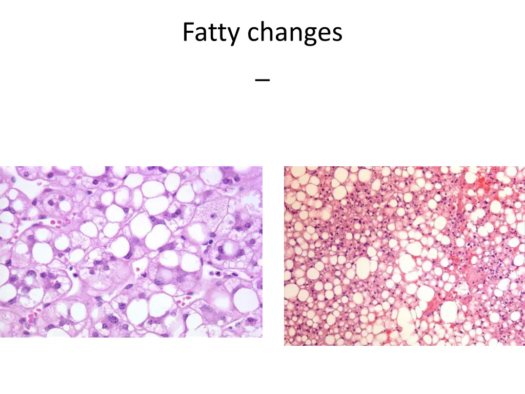 fatty changes