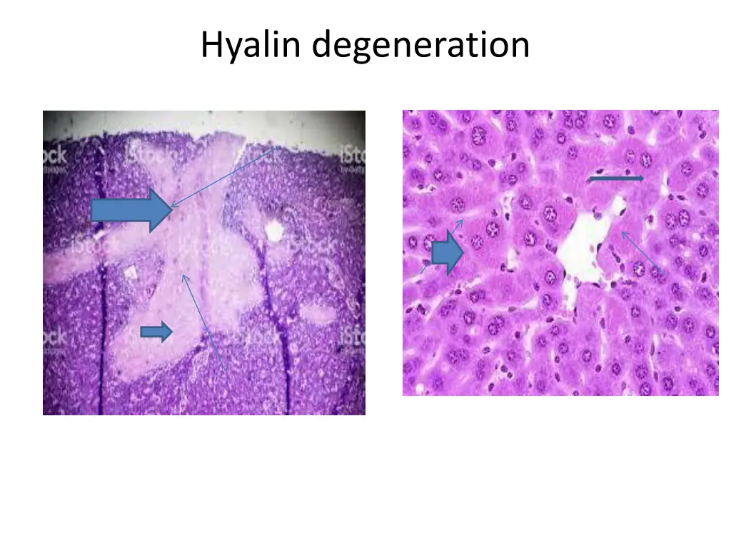 hyalin degeneration