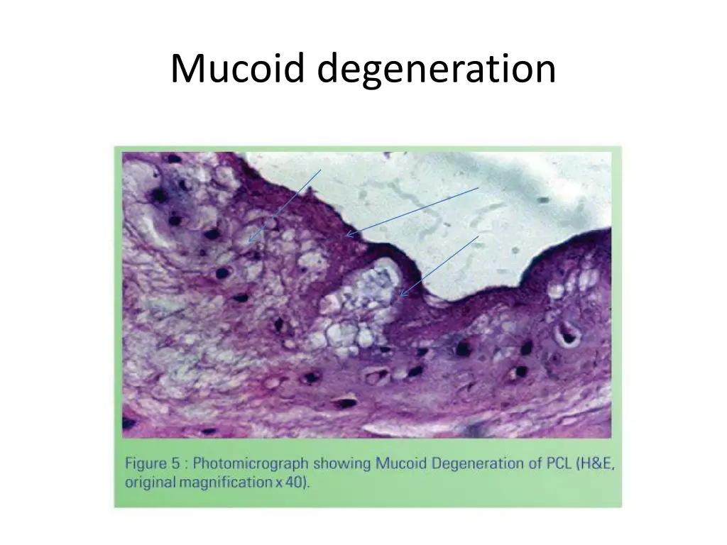 mucoid degeneration