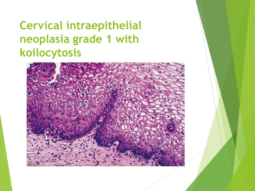 cervical intraepithelial neoplasia grade 1 with