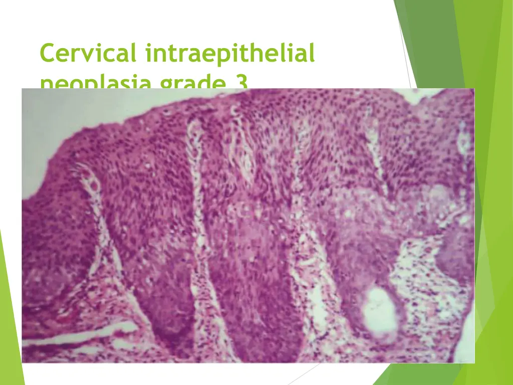 cervical intraepithelial neoplasia grade 3