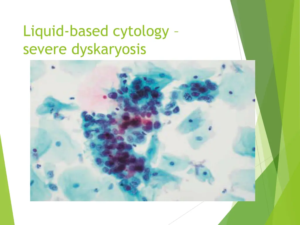 liquid based cytology severe dyskaryosis