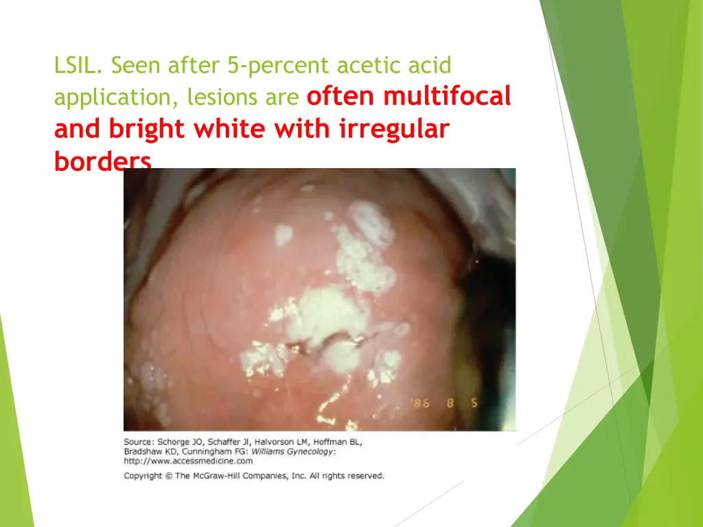 lsil seen after 5 percent acetic acid application