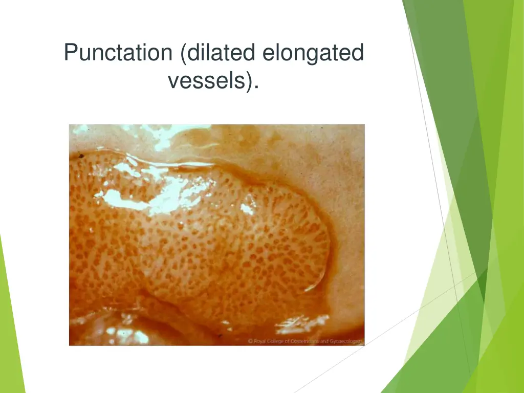 punctation dilated elongated vessels