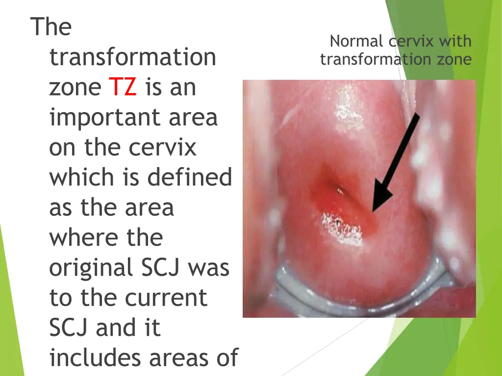 the transformation zone tz is an important area