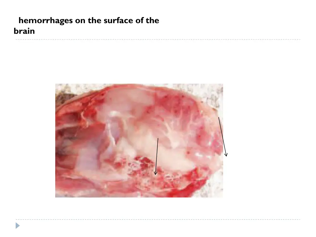 hemorrhages on the surface of the brain