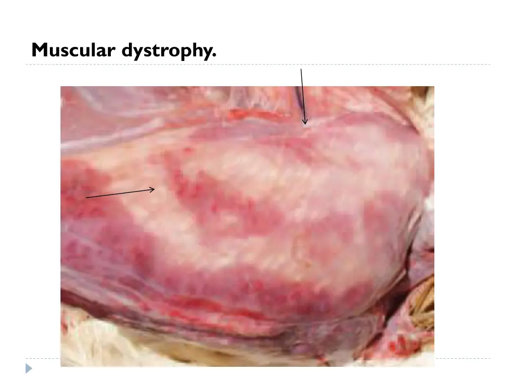 muscular dystrophy