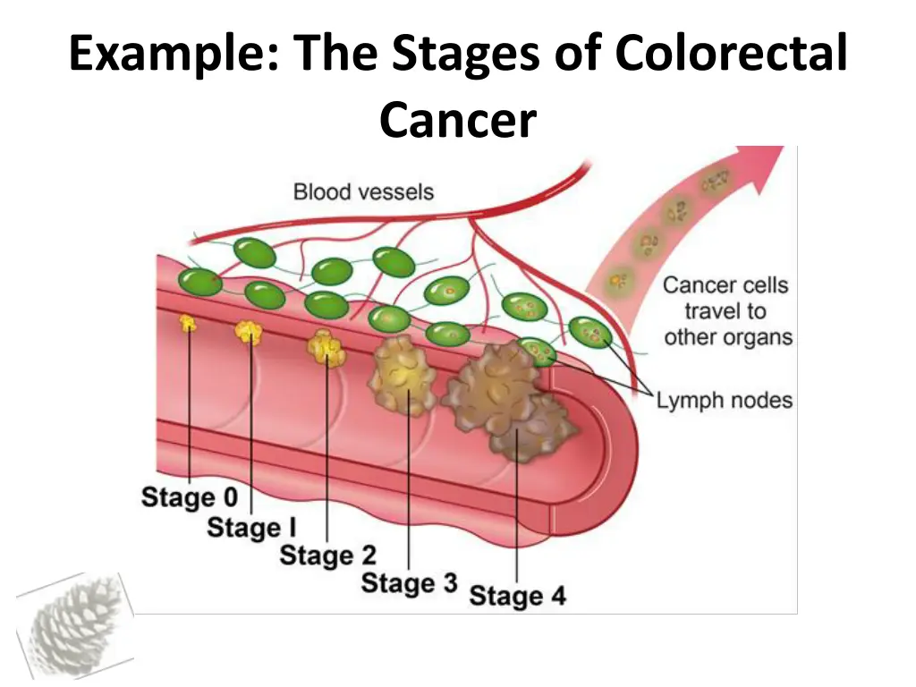 example the stages of colorectal cancer