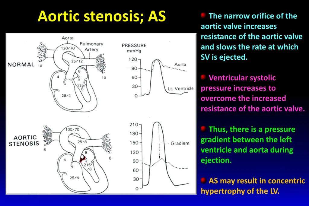 aortic stenosis as