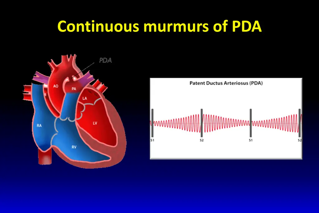 continuous murmurs of pda