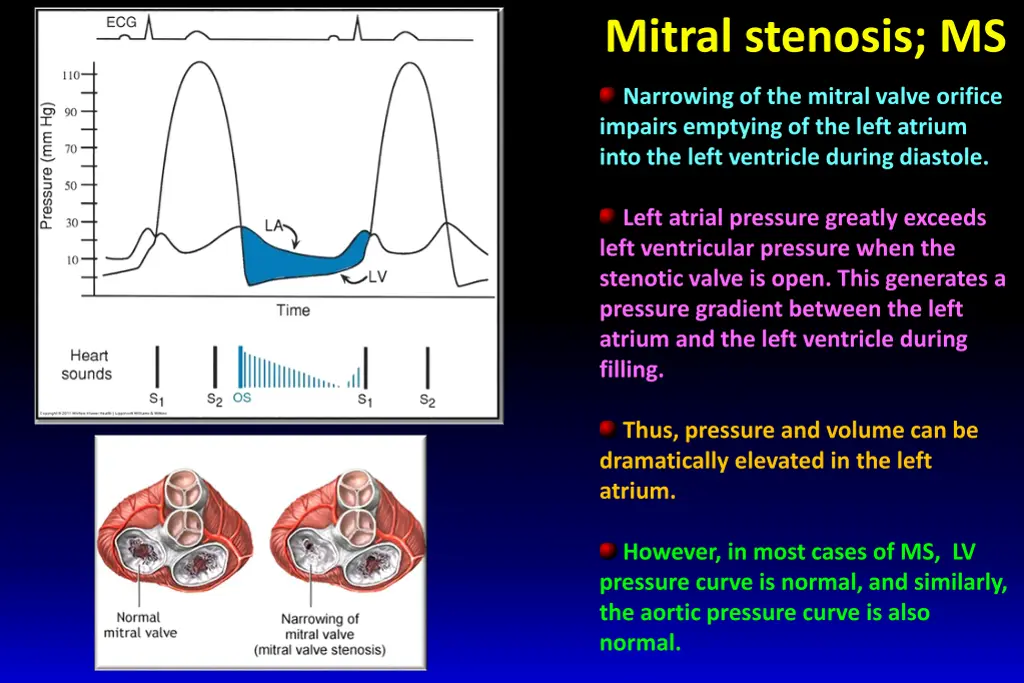 mitral stenosis ms