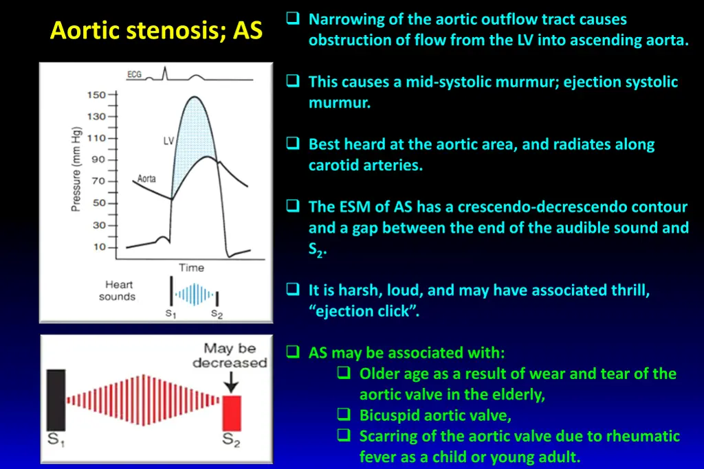 narrowing of the aortic outflow tract causes