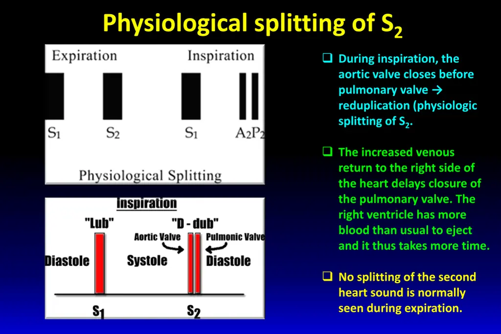 physiological splitting of s 2