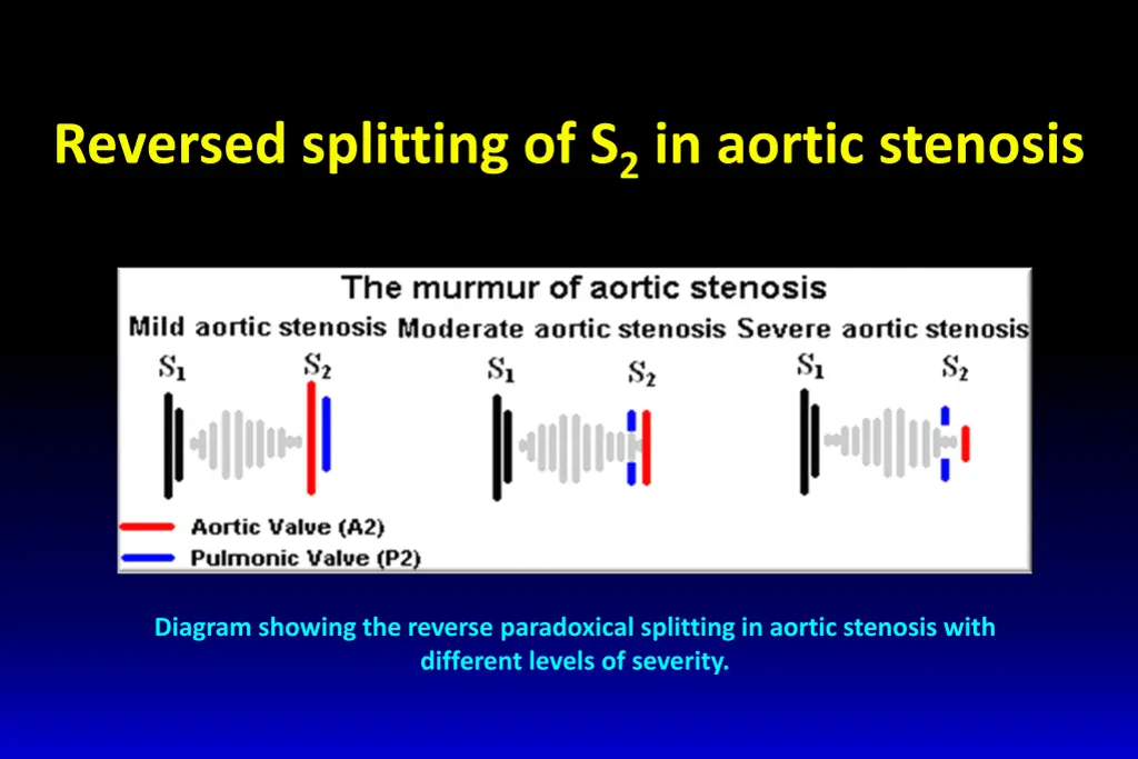 reversed splitting of s 2 in aortic stenosis