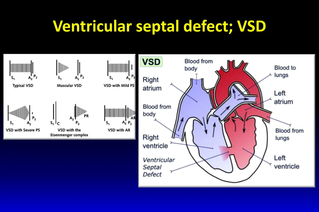 ventricular septal defect vsd