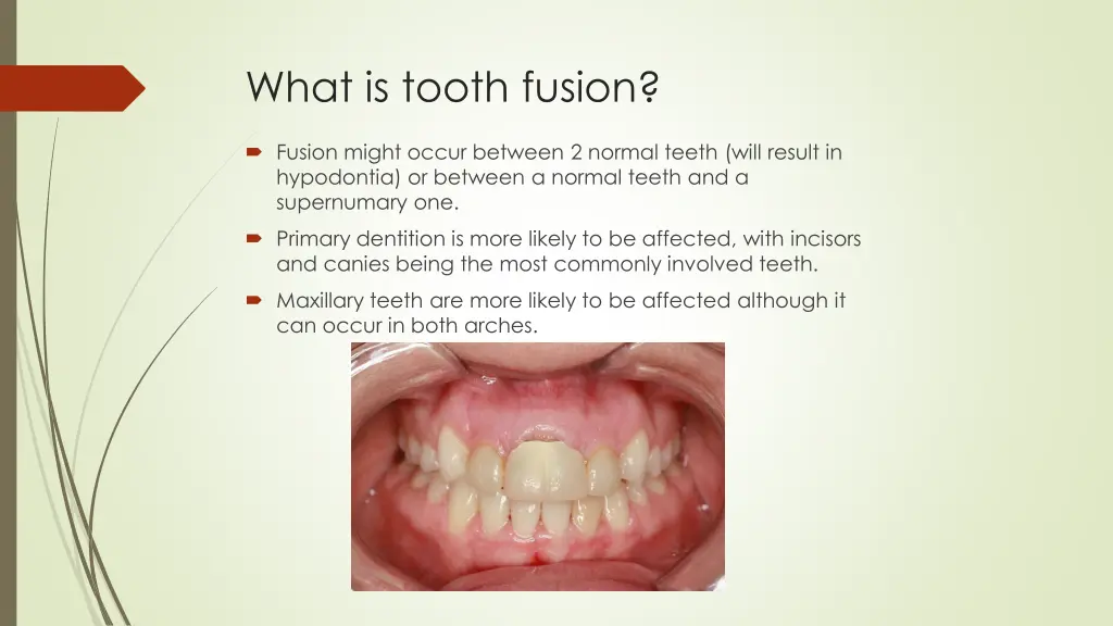 what is tooth fusion