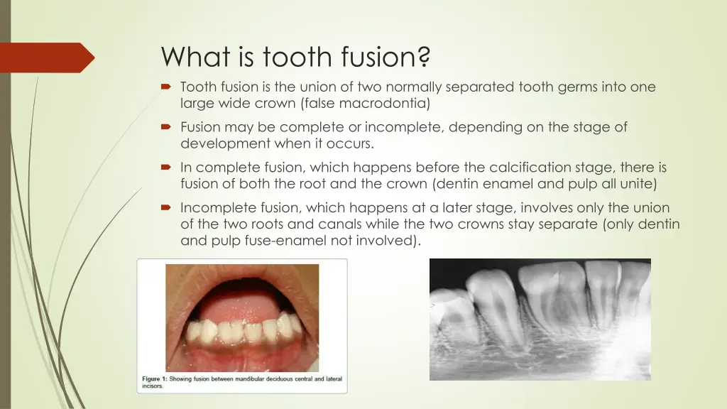 what is tooth fusion tooth fusion is the union