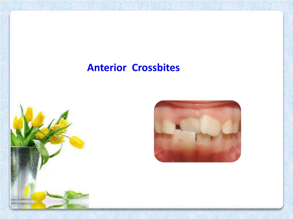 anterior crossbites