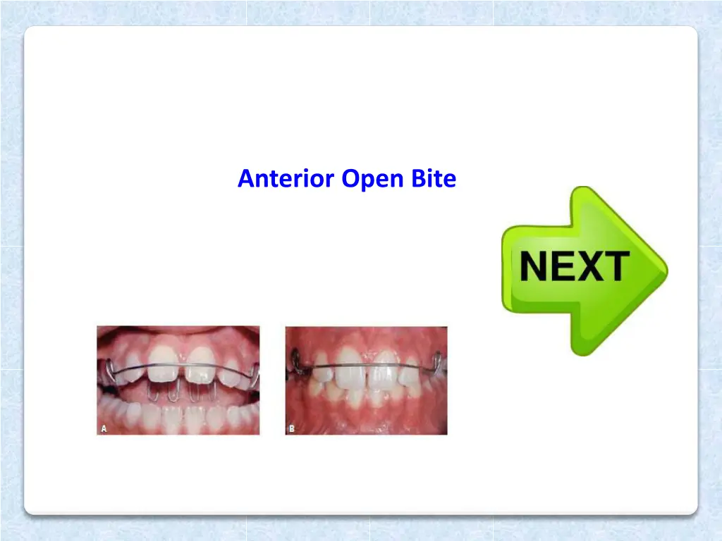 anterior open bite