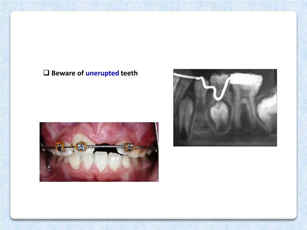 beware of unerupted teeth