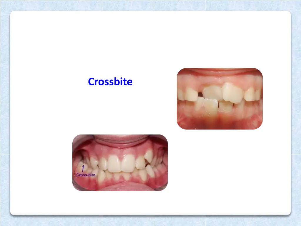 crossbite